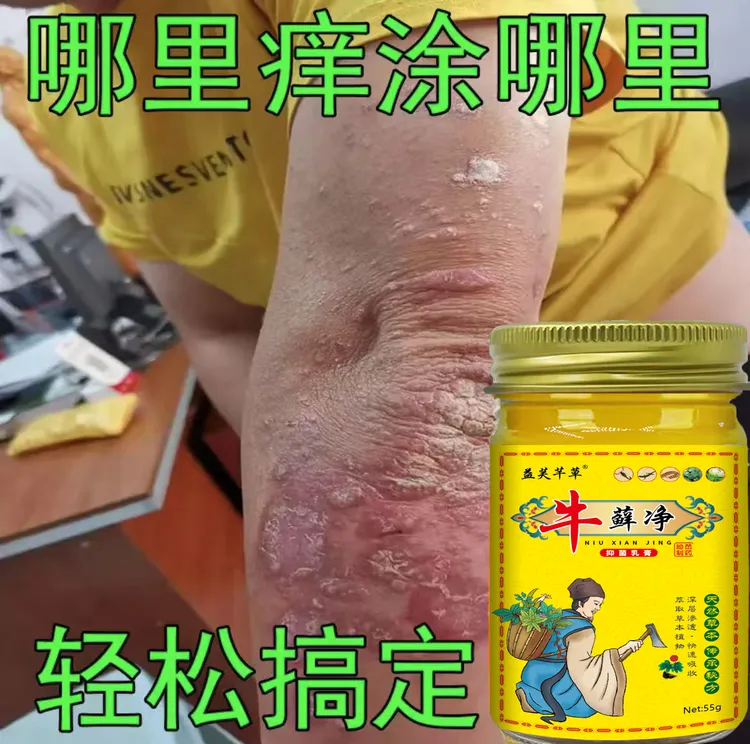 噈【牛藓净】全身牛皮廯/银屑藓头藓体藓皮焱湿诊止痒膏草本抑菌外