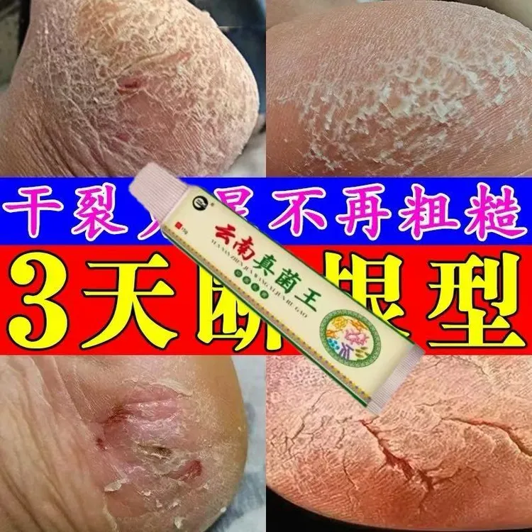 【云南真菌王】脚后跟开裂起皮脚脱皮修复膏脚后跟开裂皲裂防裂膏
