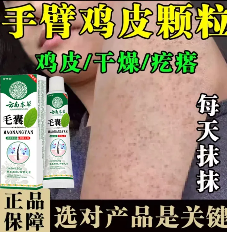胳膊腿上鸡皮疙瘩毛囊堵黑点痘痘手臂密集小颗粒腿上干燥粗糙乳膏