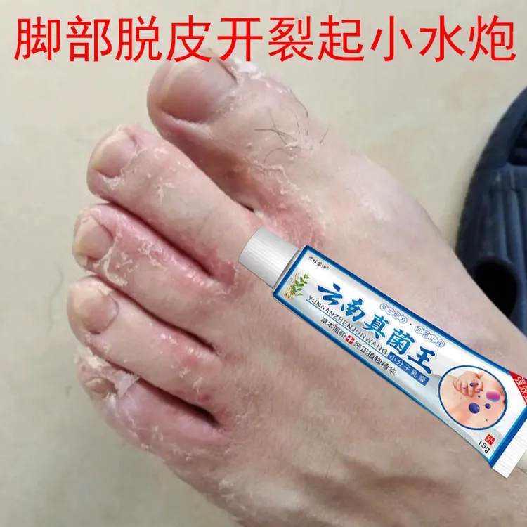正品云南真菌王抑菌止痒乳膏脚趾缝痒脚臭越抓越痒有口子起小水炮