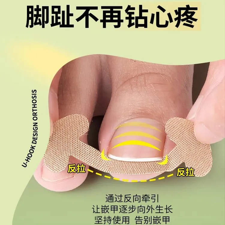 甲沟神器指甲矫正器隔离脚趾甲长肉里填充垫片纠正炎嵌甲专用拉贴