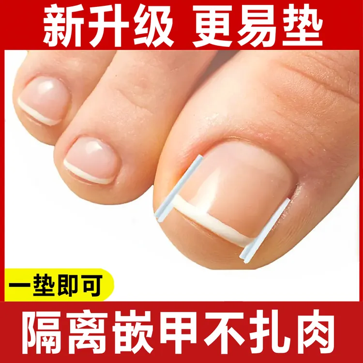 甲沟炎矫正神器嵌甲专用指甲矫正器脚指甲往肉里长纠正甲隔离垫片