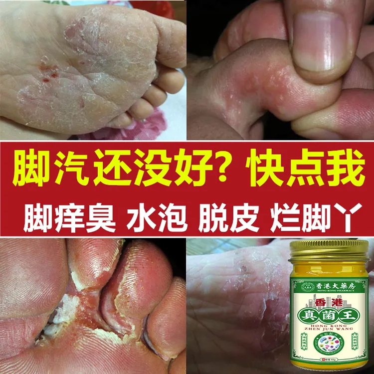 【官方正品】真菌王止痒抑菌脚臭干裂脱皮草本萃取手足部位温和外用
