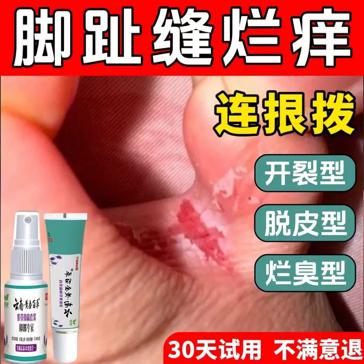 脚趾缝烂臭痒专用脚痒脚臭止痒膏神器脚脱皮抑菌膏开裂克星喷雾剂