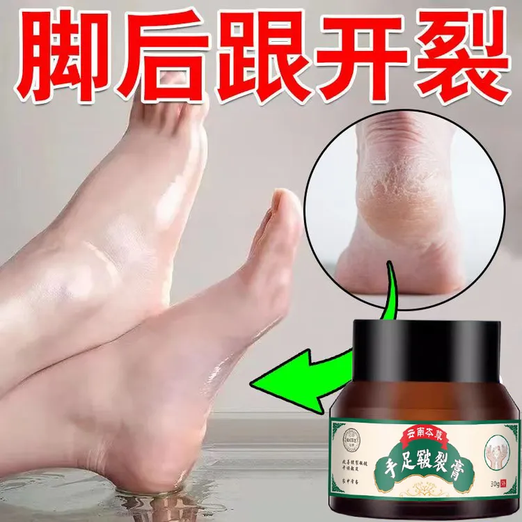 云南真菌王手足皲裂脱皮膏脚后跟干裂舒缓霜干燥粗糙护足霜脚裂膏