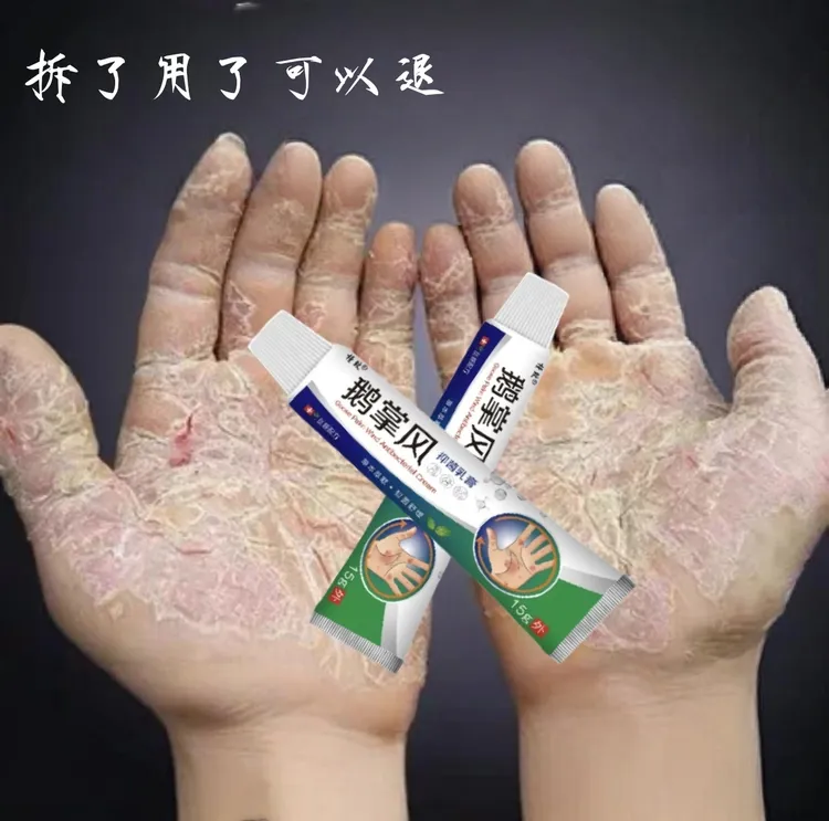 鹅 掌风手足裂口脱皮发痒手上干裂脱皮止痒草本抑菌软膏