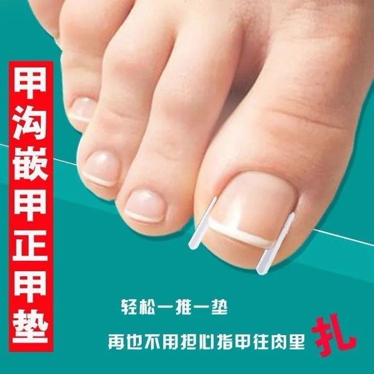 甲沟实用指甲矫正器嵌甲专用隔离填充垫片脚趾甲往肉里长纠正甲