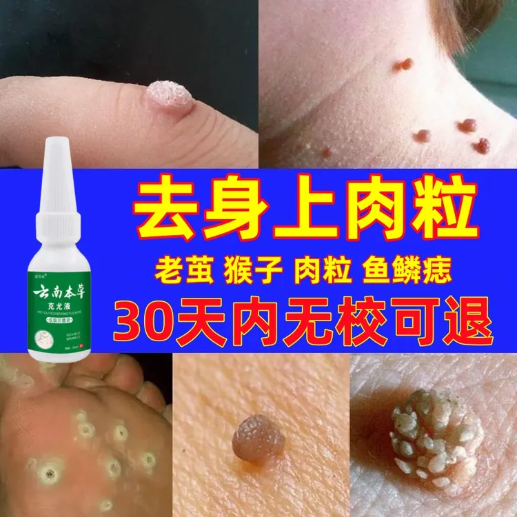 去丝状肉粒去扁平丝状脸上脖子腋下疙瘩外用小肉粒云南本草克尤液