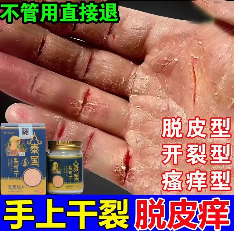 手脚跟裂口子干裂修复膏手足指头开裂防裂护手霜脱皮出血膏裂可宁