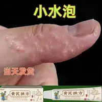 手上长水泡痒抑菌乳膏手指头长水泡珍脚上起水泡痒手上起小水泡痒