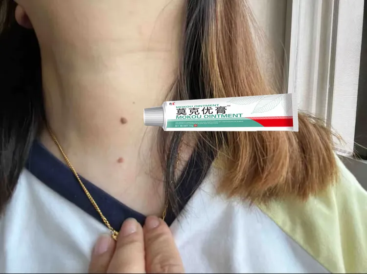 【无痕去脸上】正品小痦子膏去扁平肉刺去脖子丝状肉条小疙瘩去黑点