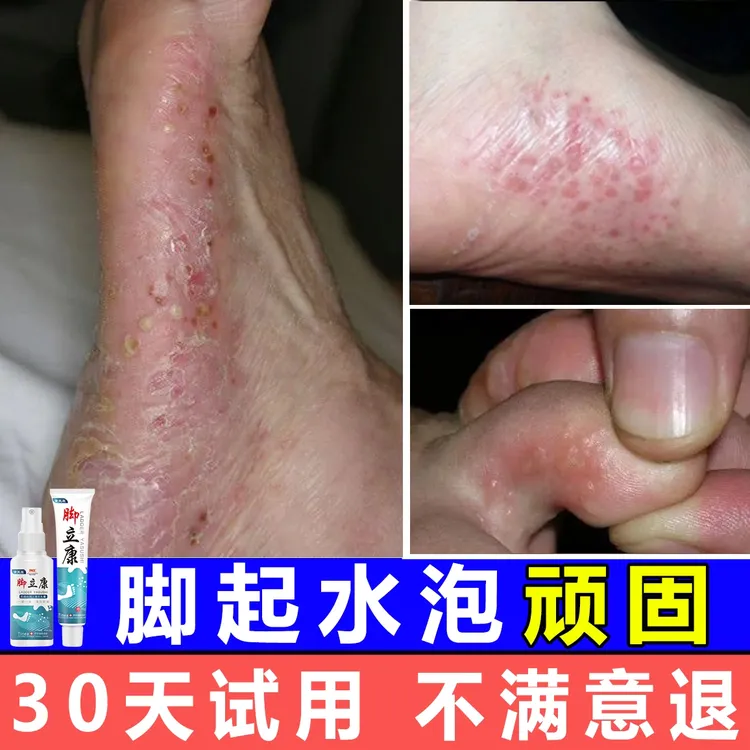 脚起小水泡痒脱皮臭气杀真菌彻底感止痒染抑菌喷雾剂特效克星神器