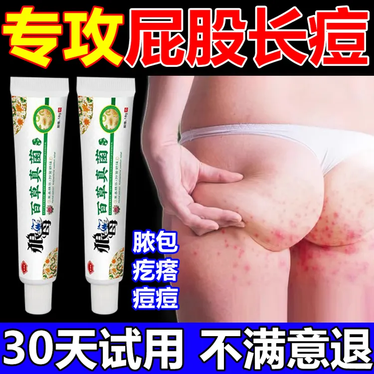 屁股长痘痘疙瘩脓包火节子湿痒止痒抑菌专用膏久坐痤长痘去除神器