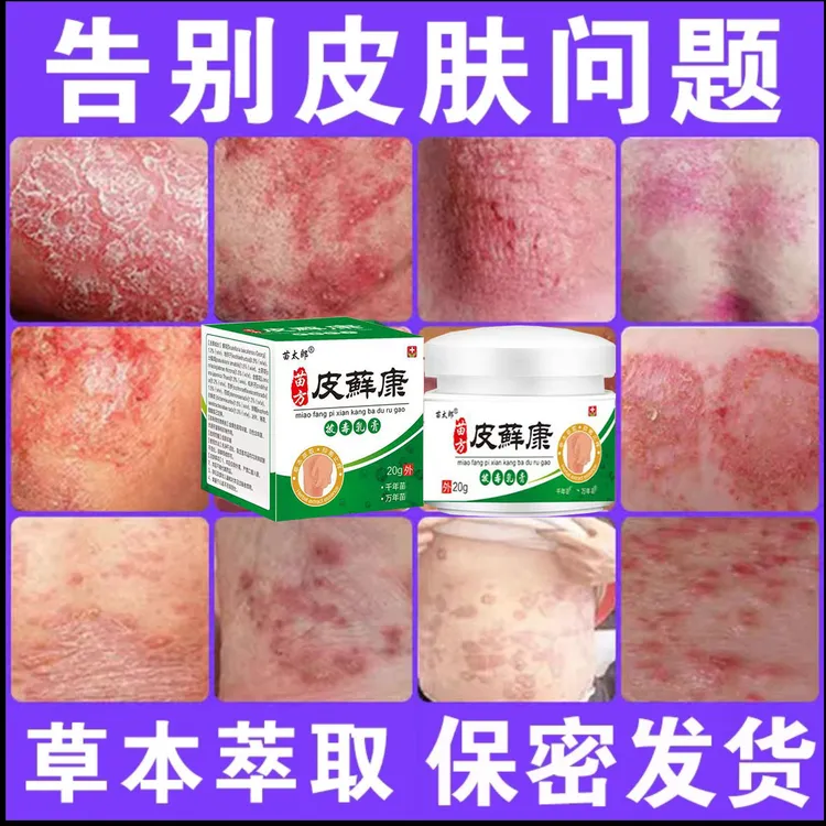 一款很牛皮的湿诊膏皮肤快速止痒全身痒草本萃取抑菌外用涂抹膏