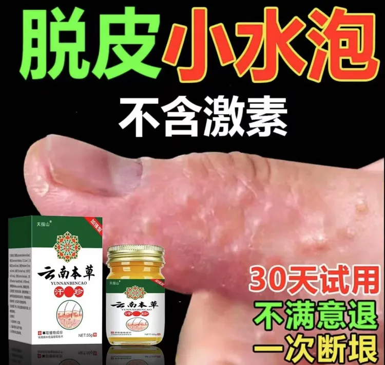 汗泡诊克星手上起小水泡止痒膏脱皮手指缝痒干裂专用草本乳膏