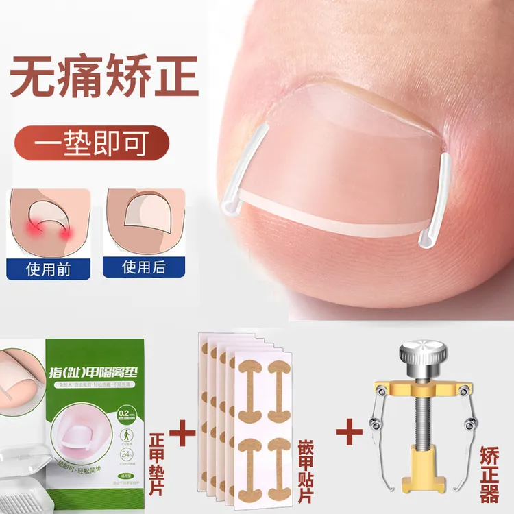 甲沟炎矫正神器嵌甲专用指甲矫正器脚指甲长肉里隔离扎肉正甲垫片