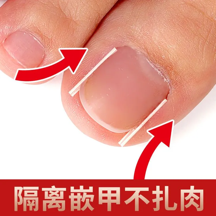 甲沟矫正神器贴片炎防止脚指甲往肉里长专用隔离嵌甲工具填充垫片