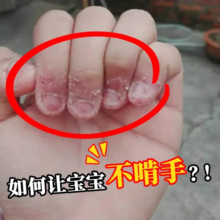 不伤手自粘纠正儿童防啃指甲神器允手指防咬手指创可贴护指甲指套