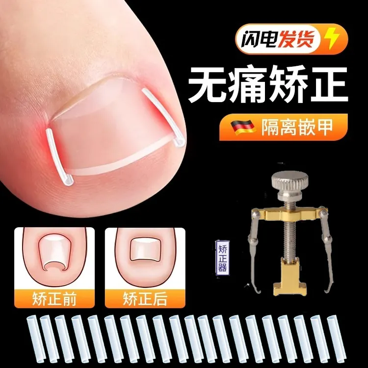甲沟炎矫正神器指甲矫正器嵌甲专用脚趾甲长肉里纠正隔离填充垫片