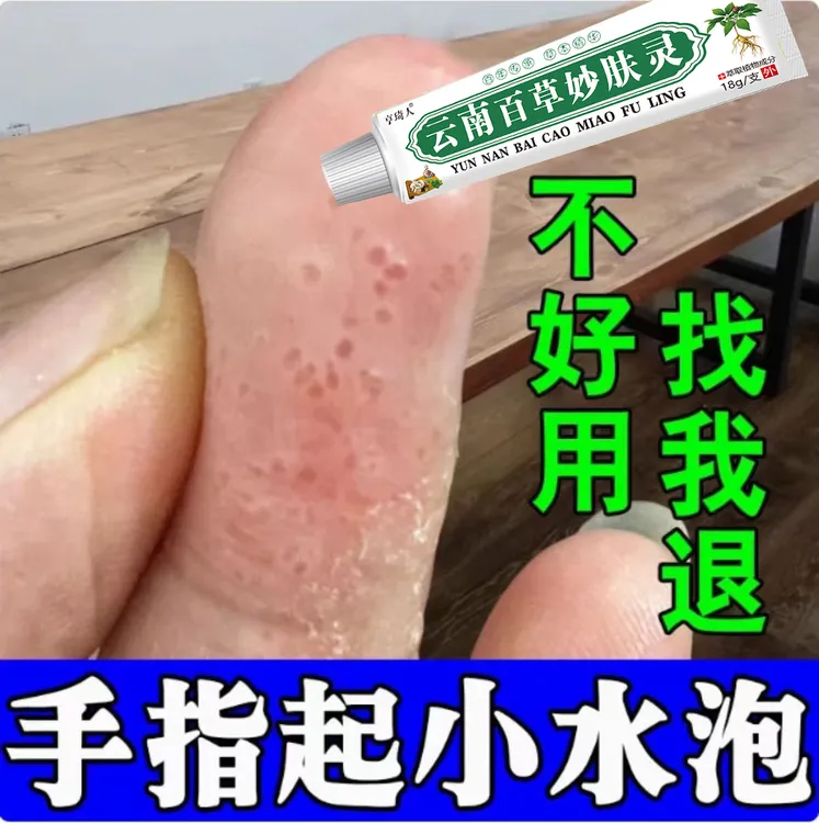 手上起小水·泡汗状水·泡痒手指脱皮专用手足脱皮抑菌膏