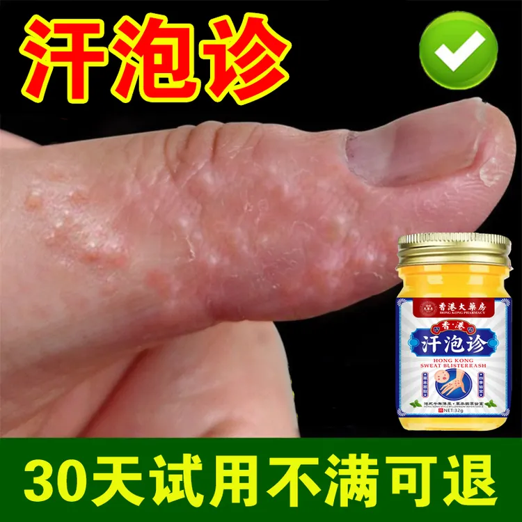 汗诊泡手上起小水泡止痒膏脱皮抑菌克星手指缝痒干裂专用草本乳膏
