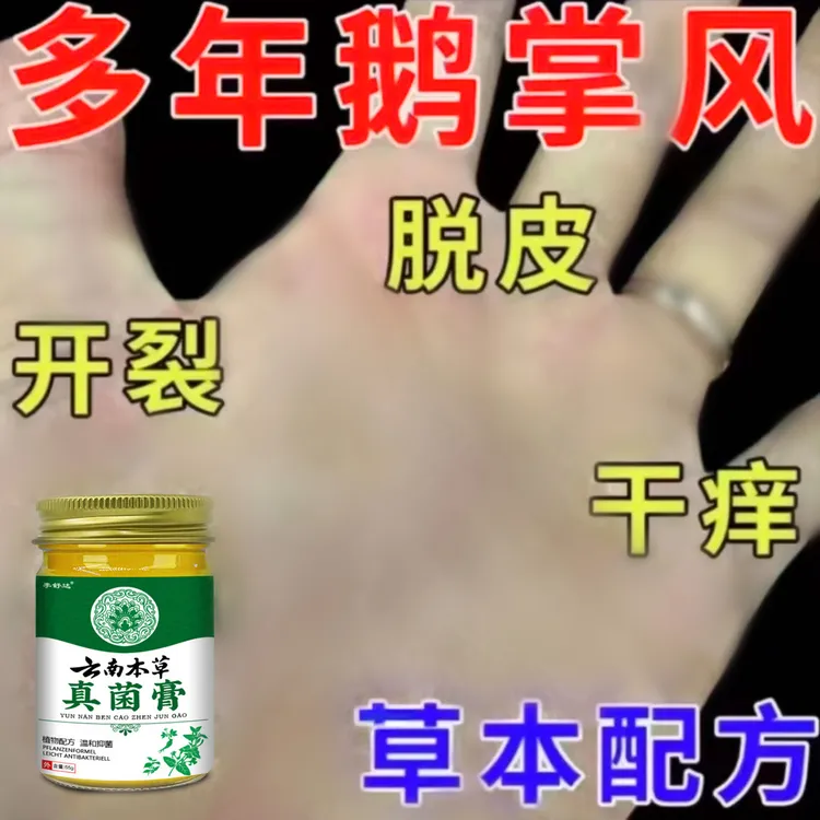 鹅掌风手足脱皮膏【效果才是硬道理】干裂脱皮手痒手裂口抑菌止痒膏
