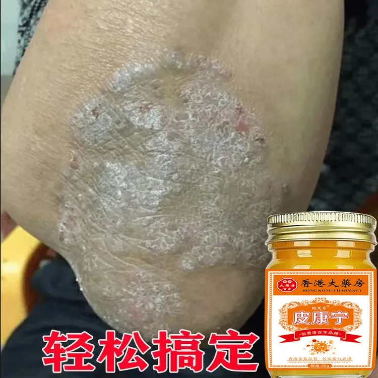 【香港皮康宁】牛皮肤银屑膏头藓顽固手足止痒大腿内侧痒全身可用