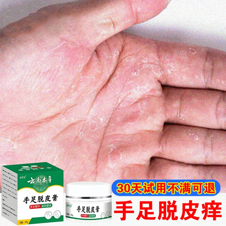 手足脱皮干裂霜严重鹅掌风手脚脱皮痒修复裂口真菌感染专用软乳膏