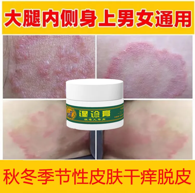 大腿内侧瘙痒越抓越痒大腿和睾丸夹缝处潮湿异味外用止痒抑菌乳膏