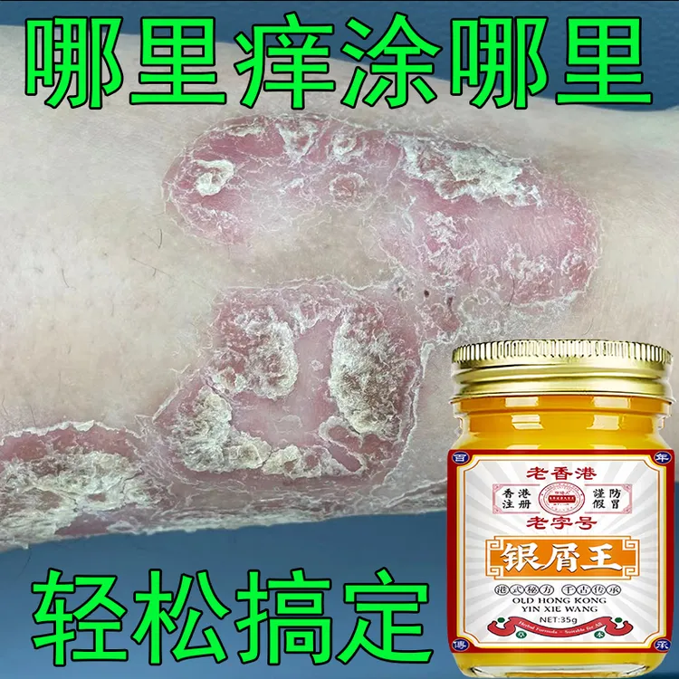 【香港银屑王】皮肤止痒牛抑菌草本温和外用止痒膏