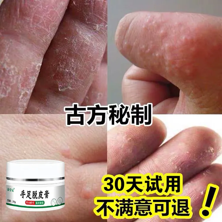 手上长小水苞手痒手足脱皮手指缝开裂手指脱皮手足起疙瘩抑菌软膏