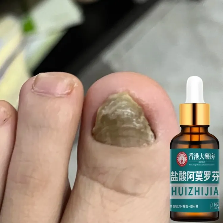 【正品直售】阿莫指甲护理擦剂手指甲脚指甲发黄发灰渗透草本液罗芬