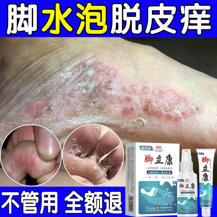 脚底脚上起小水痒泡又脱皮真菌王脚臭止痒抑菌软膏特效神器克星