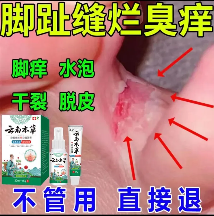 脚趾缝烂臭痒专用止痒膏脚脱皮水泡抑菌止痒神器足部正品草本套装