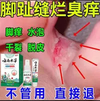 脚趾缝烂臭痒专用止痒膏脚脱皮水泡抑菌止痒神器足部正品草本套装