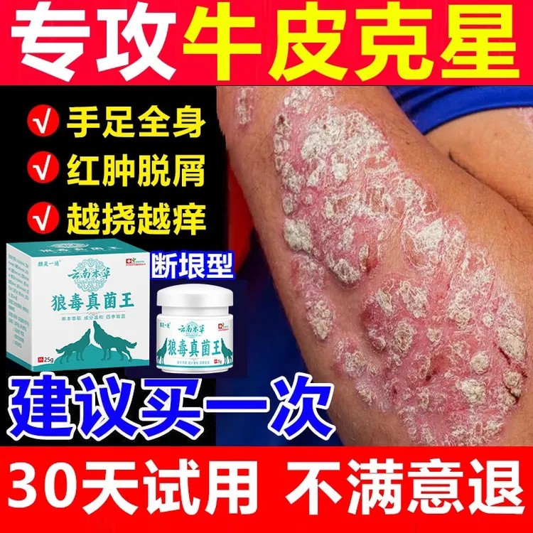 【狼毒云南王】牛皮廯肤顽固抑菌手足体股廯真菌王抑菌止痒膏