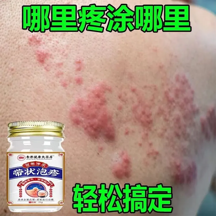 带状泡疹后遗神经痛蛇盘疮膏蛇盘清宝带状疱疹后遗症神经痛特效药