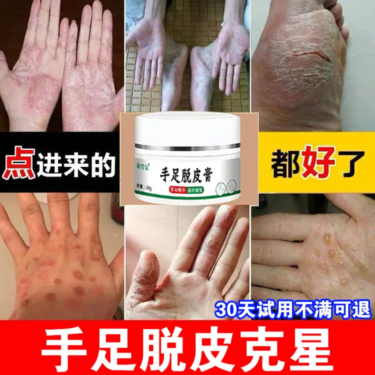 手足脱皮开裂皮肤裂口起皮干燥粗糙痒搔痒手指手掌止痒外用涂抹膏
