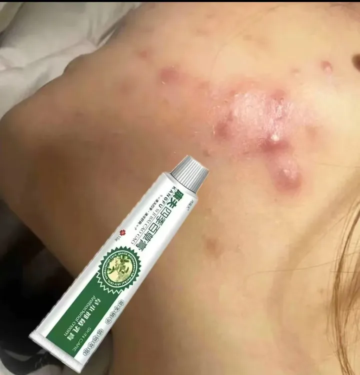 腮边痘下巴痘硬块痘痘下巴脸颊两侧脖子痘痘抑菌软膏