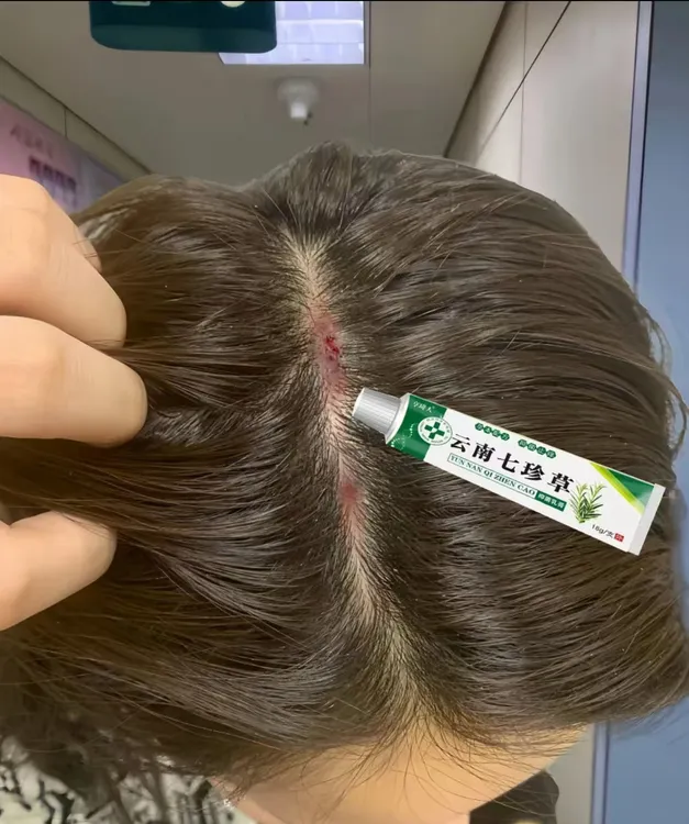 头皮头痒头上疙瘩头上长痘痘起干皮头上毛囊严深层抑菌膏