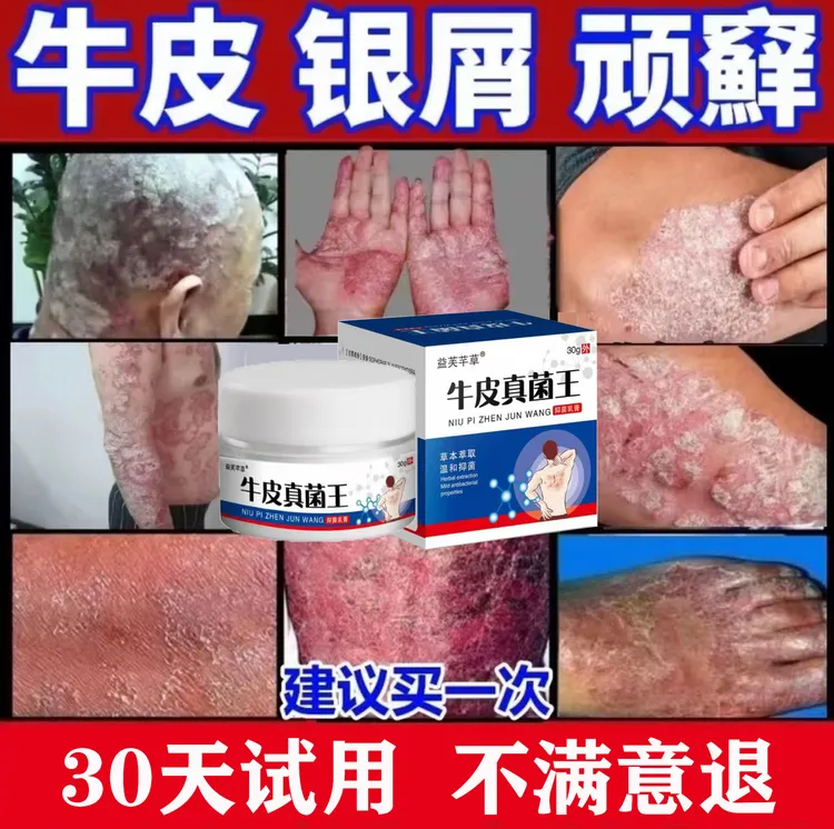 【牛皮真菌王】全身牛皮廯/银屑藓头藓体藓皮焱湿诊止痒膏草本抑菌