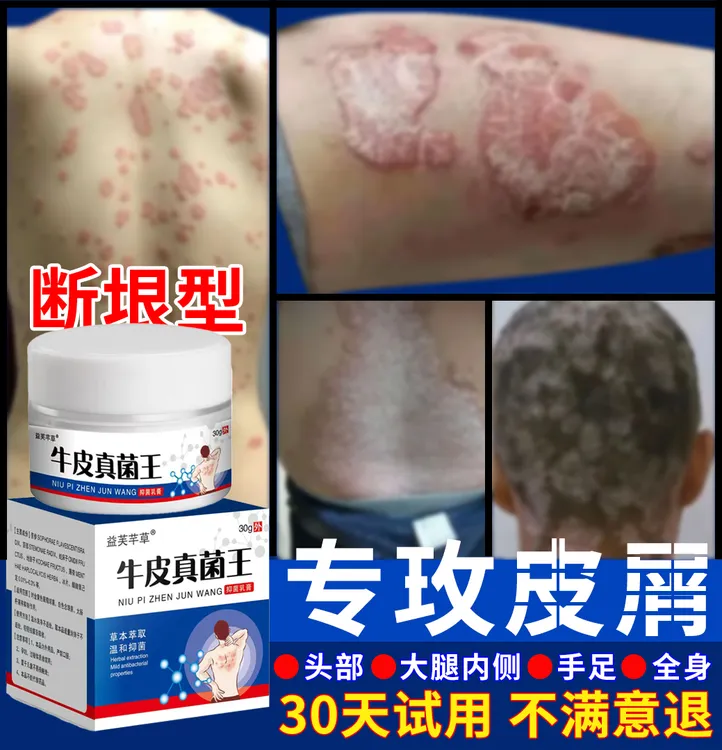 【垠屑王】牛用皮肤头蘚膏顽固手足股红点止痒大腿内侧全身用真菌王