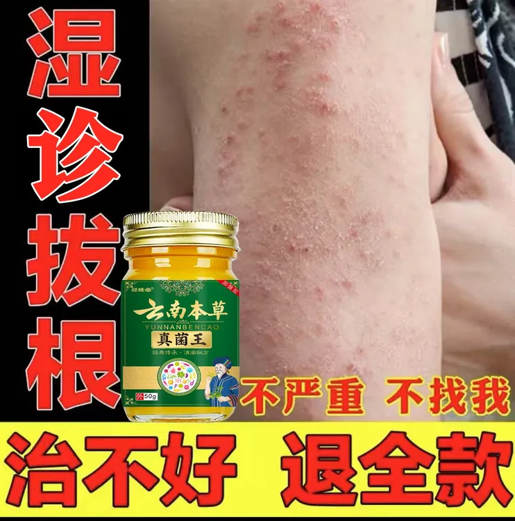 【一款很牛的湿诊膏】皮肤快速止痒膏全身通用草本水泡涂抹外用乳膏