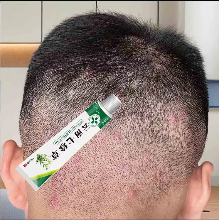 头皮头痒头上疙瘩头上长痘痘起干皮头上毛囊严深层抑菌膏