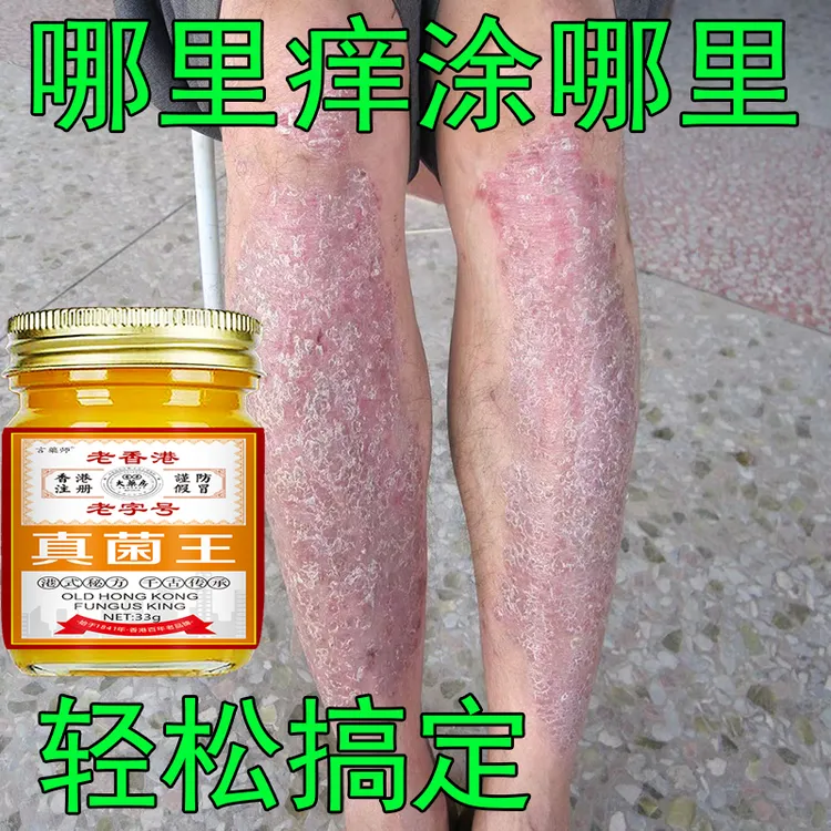 【香港真菌王】全身牛皮/银屑/藓头皮手足体藓大腿内侧草本止痒癣膏