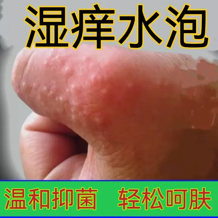 汗疹克星手上起小水泡止痒膏脱皮抑菌手指缝痒干裂专用草本乳膏