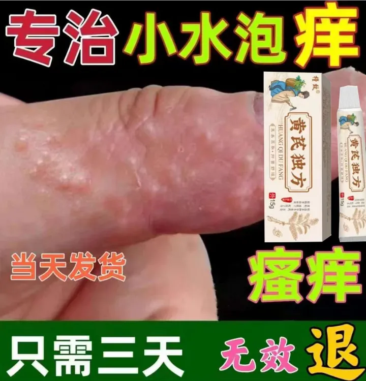 春季皮肤痒小腿痒痒的总想挠腿部起红疙瘩春季皮肤干燥抓出血乳膏