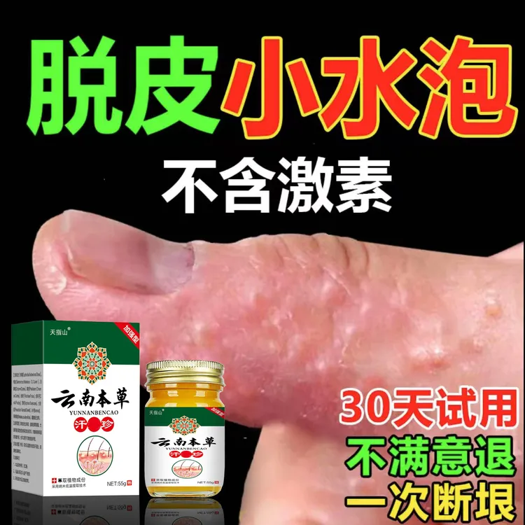 手上长小水泡手痒手指缝开裂手指足部脱皮手足起疙瘩抑菌软膏