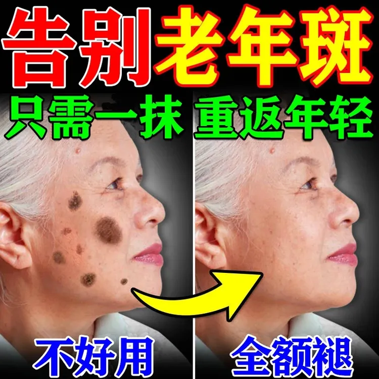 手背斑老年斑脸部黑斑黄褐斑专用中草膏