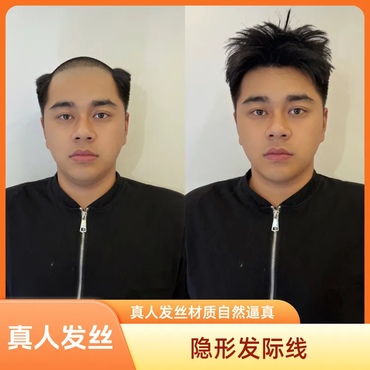 【全递针】真发全新高级隐形发际线男士假发【定制款】男士假头发